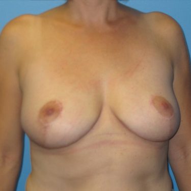 Breast Reduction After Patient 9