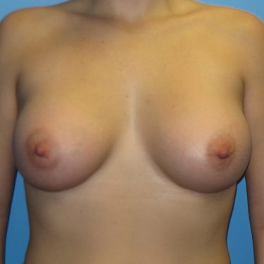 Subglandular After Patient 8