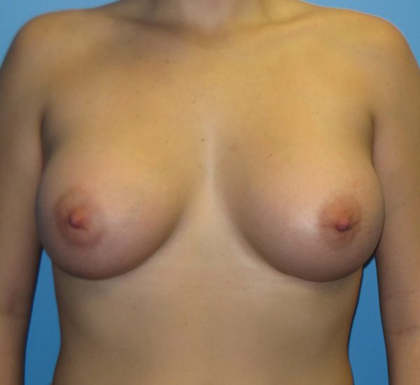 Breast Augmentation After Patient 1
