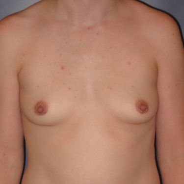 Breast Augmentation Before Patient 8