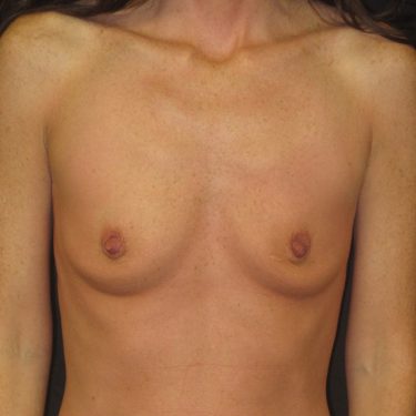 Breast Augmentation Before Patient 7