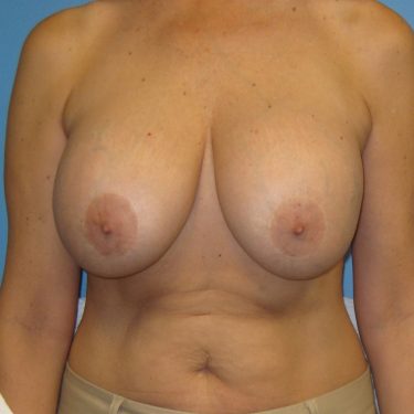 Revision of Others' Work Before Patient 4