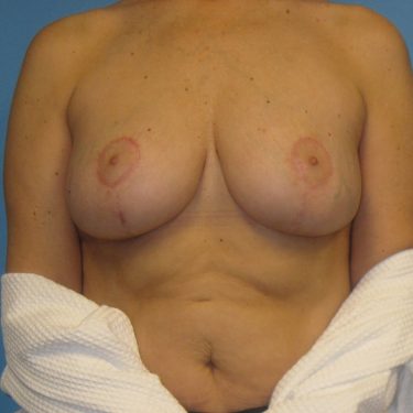 Revision of Others' Work After Patient 4