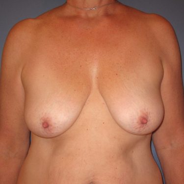 Breast Lift Before Patient 29