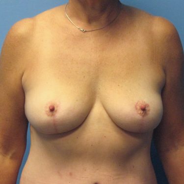 Breast Lift After Patient 29