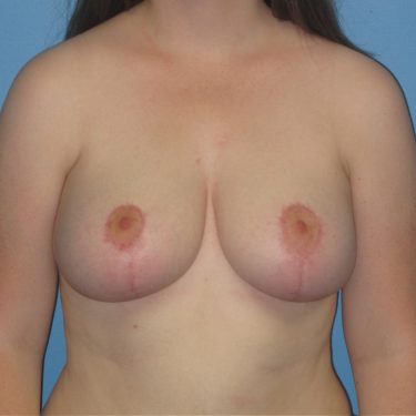 Breast Reduction After Patient 24