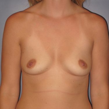 Breast Augmentation Before Patient 6