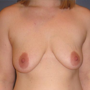 Breast Lift Before Patient 28