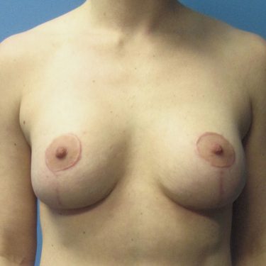 Breast Augmentation with Lift After Patient 6