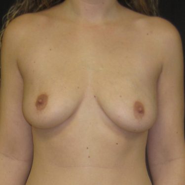 Breast Augmentation Before Patient 4