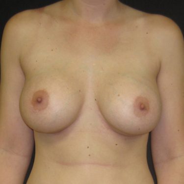 Breast Augmentation After Patient 4