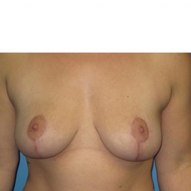 Breast Lift After Patient 27