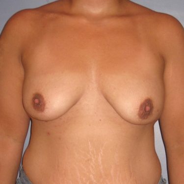 Subglandular Before Patient 7