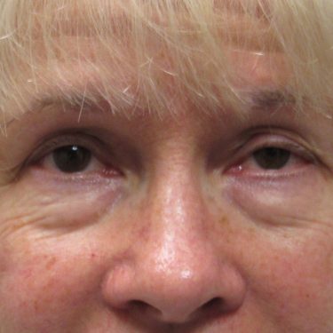 Eyes & Brow Before Patient 7