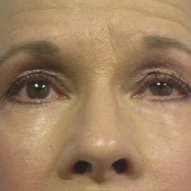 Eyes & Brow After Patient 7