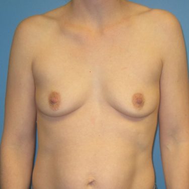 Breast Augmentation Before Patient 2