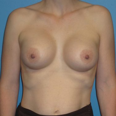Breast Augmentation After Patient 2
