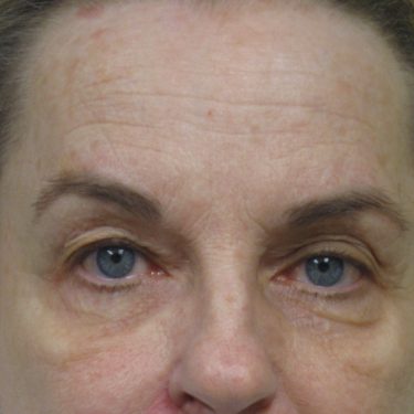 Eyes & Brow Before Patient 6