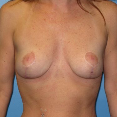 Breast Lift After Patient 26