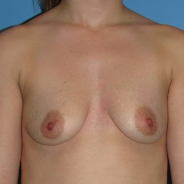 Dual-plane technique Before Patient 12