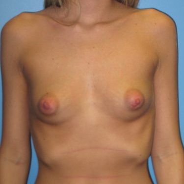 Dual-plane technique Before Patient 11