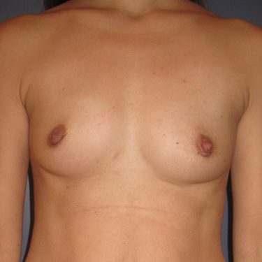 Breast Augmentation Before Patient 28