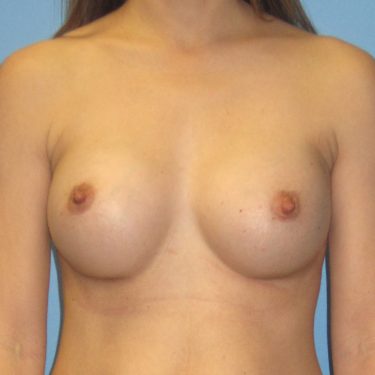 Breast Augmentation After Patient 28