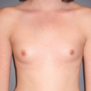 Breast Augmentation Before Patient 3