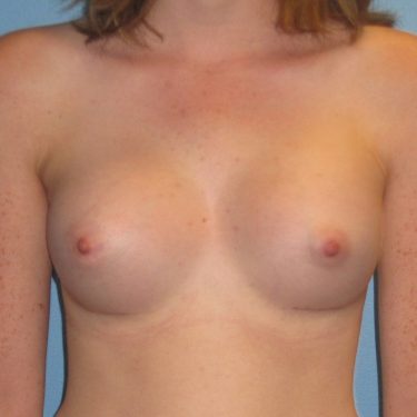 Breast Augmentation After Patient 3