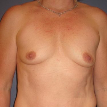 Breast Augmentation Before Patient 27