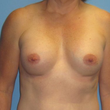 Breast Augmentation After Patient 27