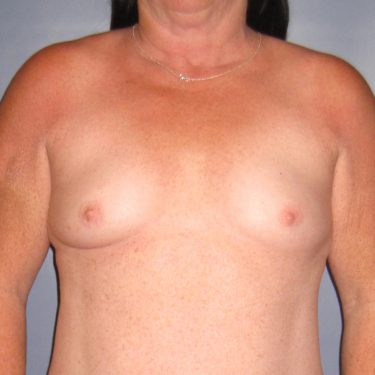 Subglandular Before Patient 6