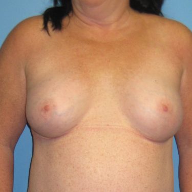 Subglandular After Patient 6