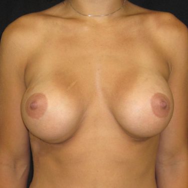 Subglandular After Patient 5