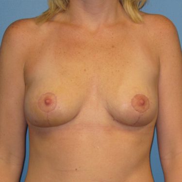 Breast Lift After Patient 24