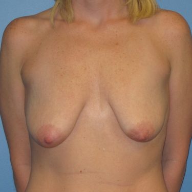 Breast Augmentation with Lift Before Patient 5