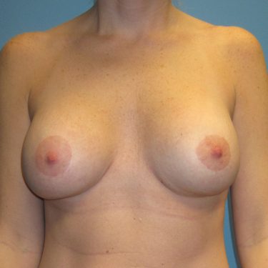 Breast Augmentation with Lift After Patient 5