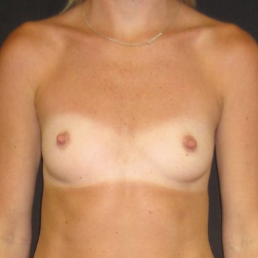Breast Augmentation Before Patient 22