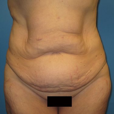 Tummy Tuck Before Patient 23