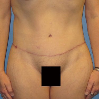 Tummy Tuck After Patient 23