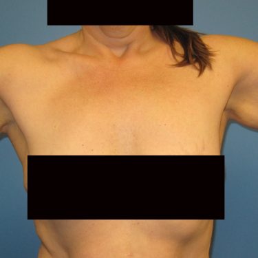 Brachioplasty Before Patient 3