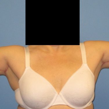 Brachioplasty After Patient 3