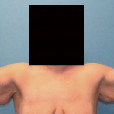 Brachioplasty Before Patient 2