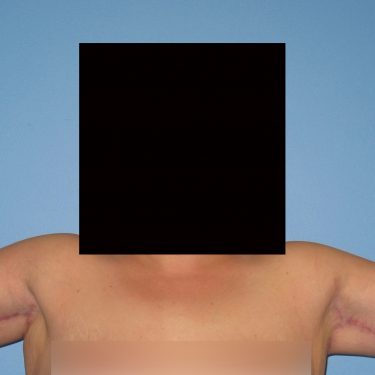 Brachioplasty After Patient 2