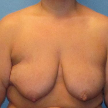 Breast Lift Before Patient 23