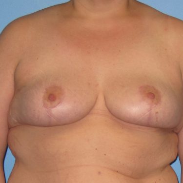 Surgery After Weight Loss After Patient 11