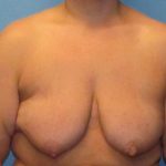 Breast Augmentation & Lift Before Patient Thumbnail 1