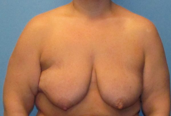 Breast Augmentation & Lift Before Patient 1