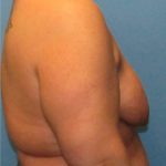 Breast Augmentation & Lift Before Patient Thumbnail 3