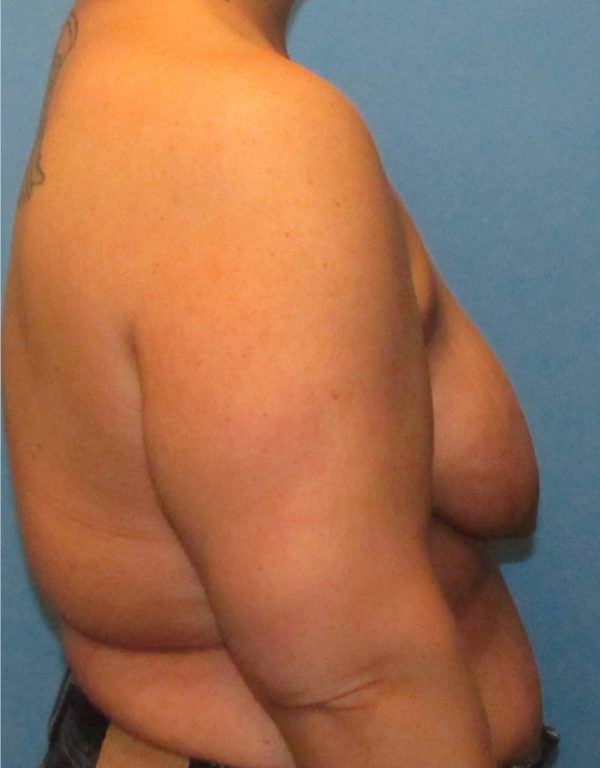 Breast Augmentation & Lift Before Patient 3